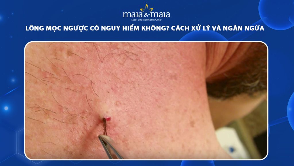 lông mọc ngược