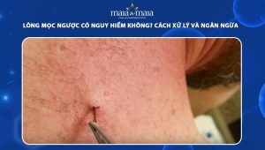 lông mọc ngược