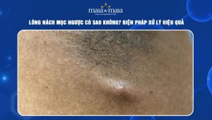 Lông nách mọc ngược