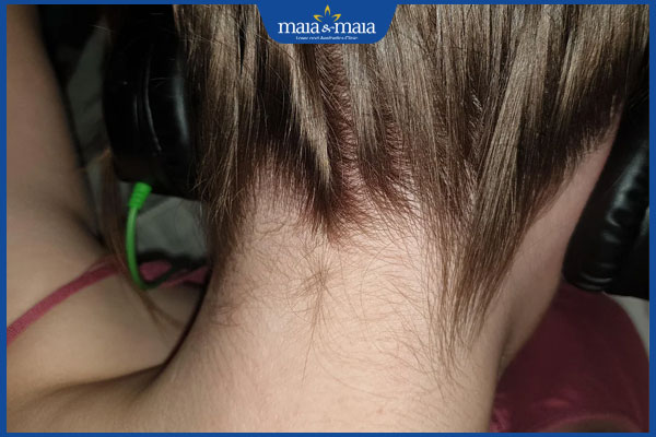 lông vùng gáy rậm