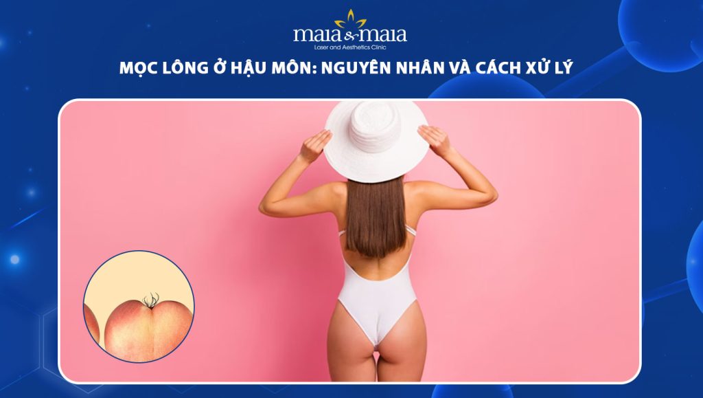 Mọc lông ở hậu môn: Nguyên nhân và cách xử lý 1 mọc lông ở hậu môn