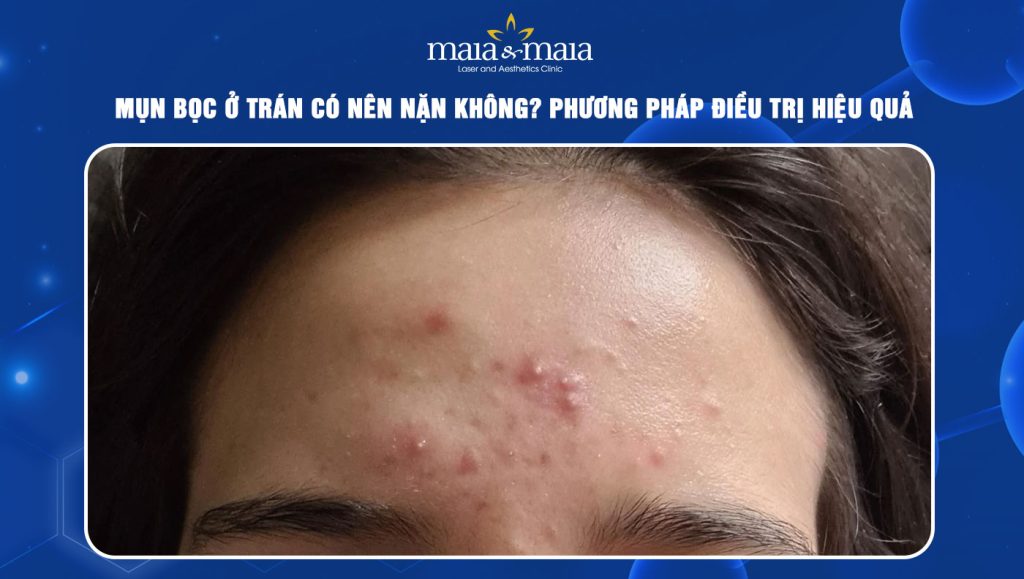 Mụn bọc ở trán có nên nặn không? Giải pháp điều trị hiệu quả 1 Mụn bọc ở trán