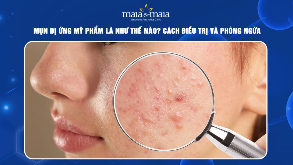 mụn dị ứng mỹ phẩm