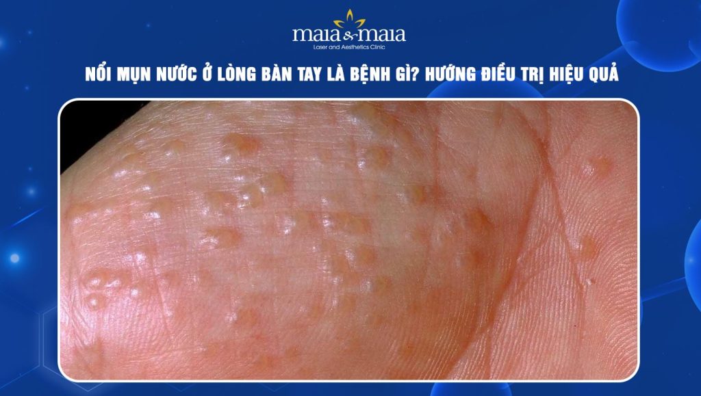 Mụn nước ở lòng bàn tay là như nào? Hướng điều trị hiệu quả 1 Mụn nước ở lòng bàn tay
