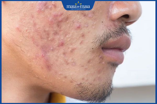 Bí quyết wax râu cho nam an toàn tại nhà và lưu ý cần nhớ 8 nam giới có mụn