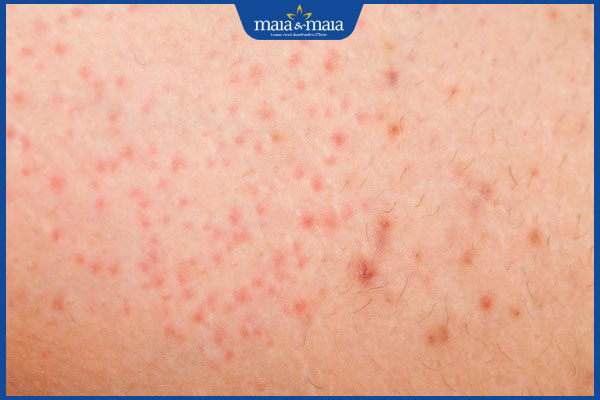 Có nên dùng kem tẩy lông không? Tìm hiểu ưu và nhược điểm 3 ngứa ngáy sau tẩy lông