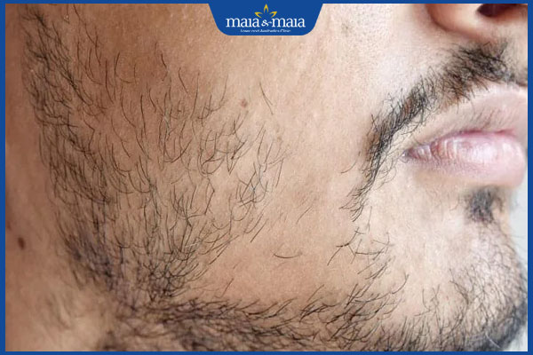 người có râu không đều