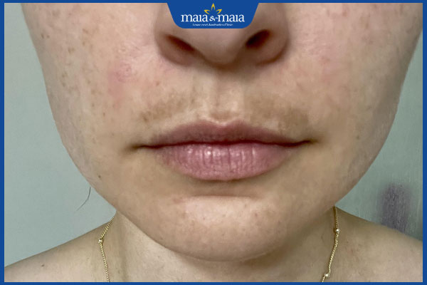 nguyên nhân ria mép đậm màu