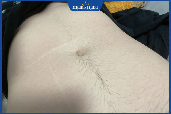 nhiều lông bụng