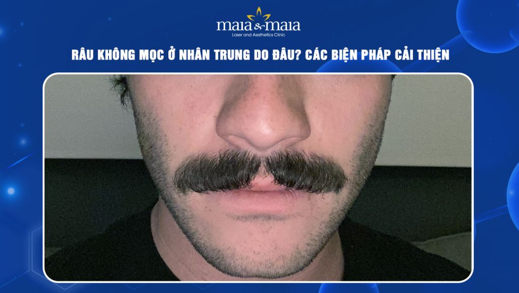 Râu không mọc ở nhân trung do đâu? Các biện pháp cải thiện 1 Râu không mọc ở nhân trung