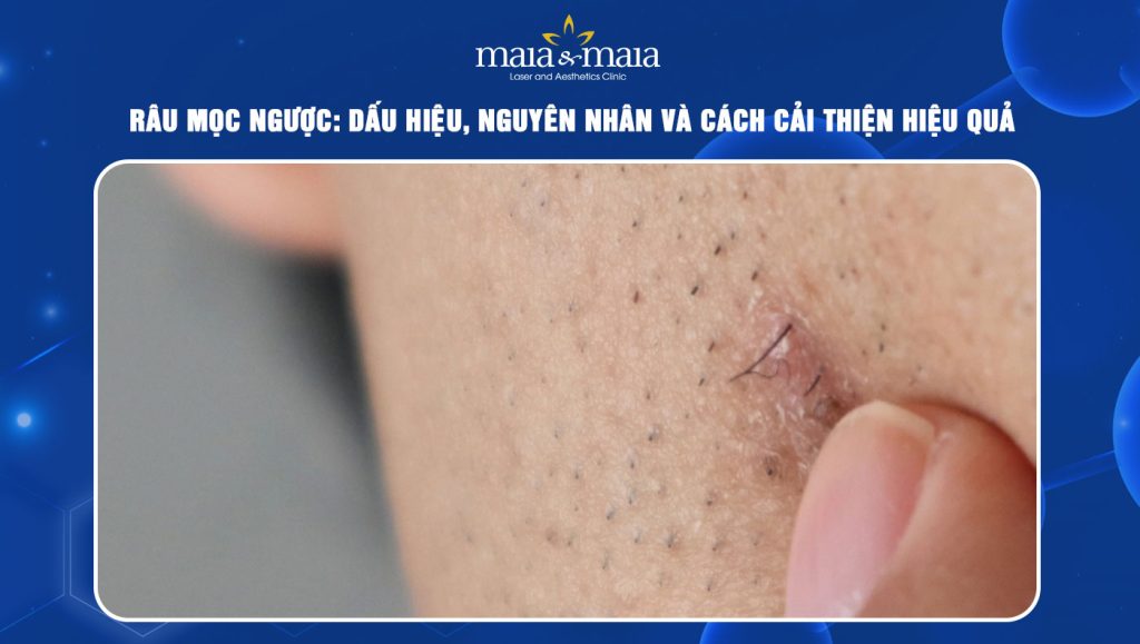 Râu mọc ngược: Dấu hiệu, nguyên nhân và cách cải thiện 1 râu mọc ngược