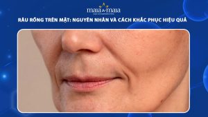 râu rồng trên mặt