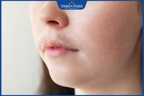 ria mép nhiều ở nữ giới