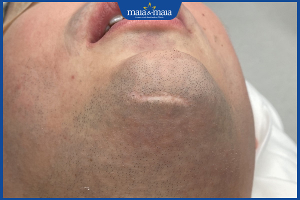 sẹo ở vùng cằm