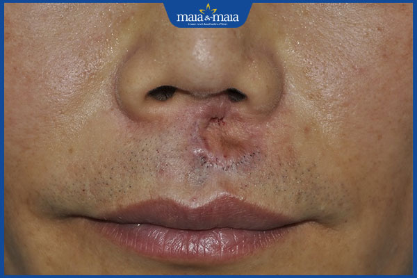 Râu không mọc ở nhân trung do đâu? Các biện pháp cải thiện 2 sẹo ở vùng nhân trung