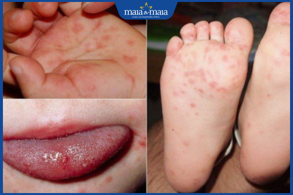 Mụn nước ở lòng bàn tay là như nào? Hướng điều trị hiệu quả 3 tay chân miệng gây mụn