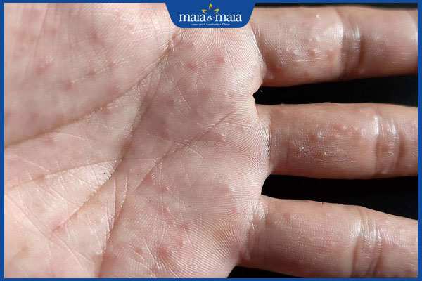 Mụn nước ở lòng bàn tay là như nào? Hướng điều trị hiệu quả 2 tay nổi mụn nước