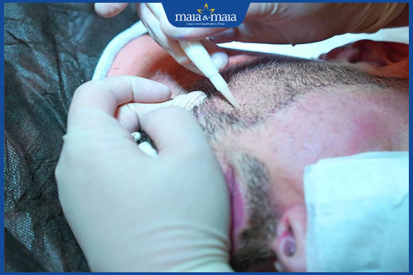 thực hiện cấy râu quai nón