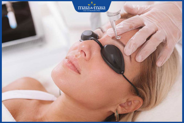 thực hiện triệt lông mày