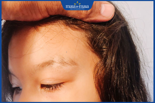 tình trạng lông mày đứt đoạn