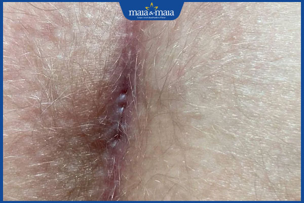 Mọc lông ở hậu môn: Nguyên nhân và cách xử lý 2 tình trạng mọc lông ở hậu môn