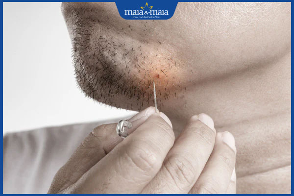 Râu mọc ngược: Dấu hiệu, nguyên nhân và cách cải thiện 2 tình trạng râu mọc ngược