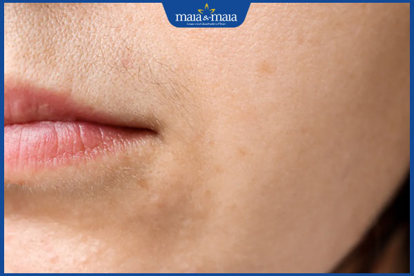 tình trạng ria mép ở nữ