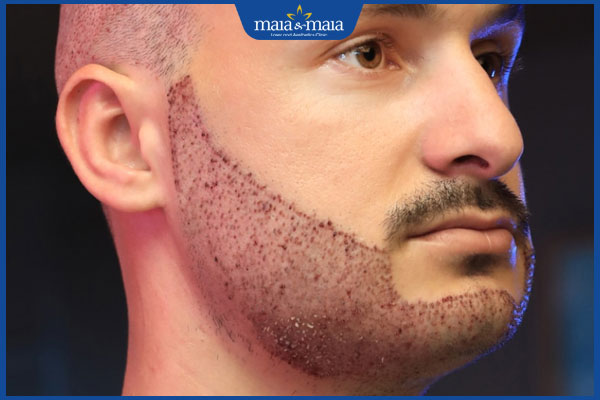 tình trạng sau cấy râu