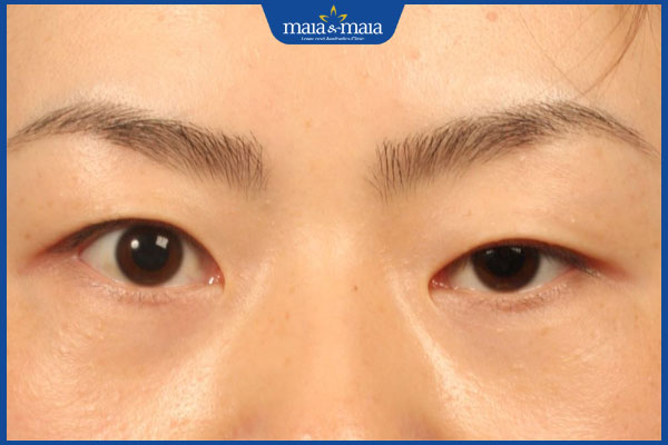 tình trạng sụp mí