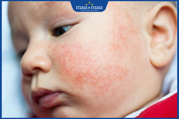 trẻ sơ sinh viêm da cơ địa