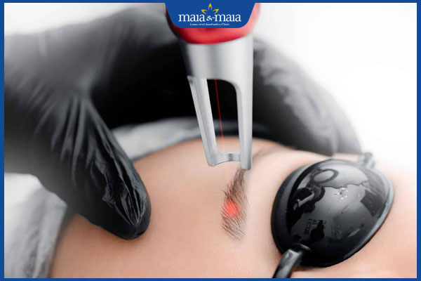triệt lông mày bằng laser