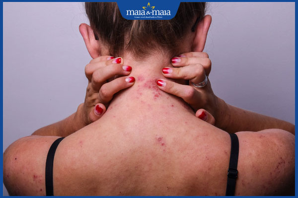 Tổng hợp hình ảnh viêm da cơ địa ở người lớn và trẻ em 5 viêm da cơ địa lưng gáy