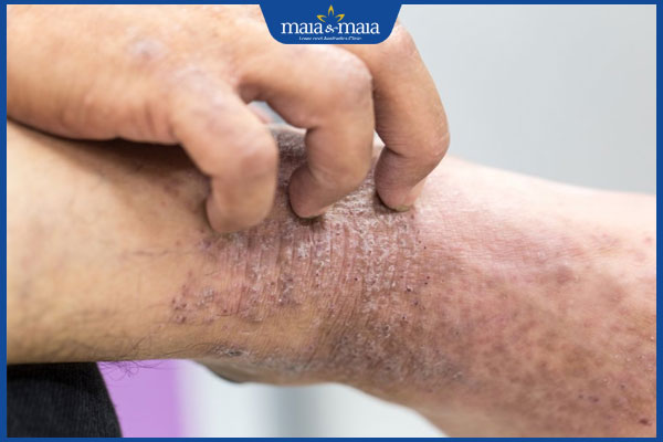 Tổng hợp hình ảnh viêm da cơ địa ở người lớn và trẻ em 6 viêm da cơ địa ngứa người lớn