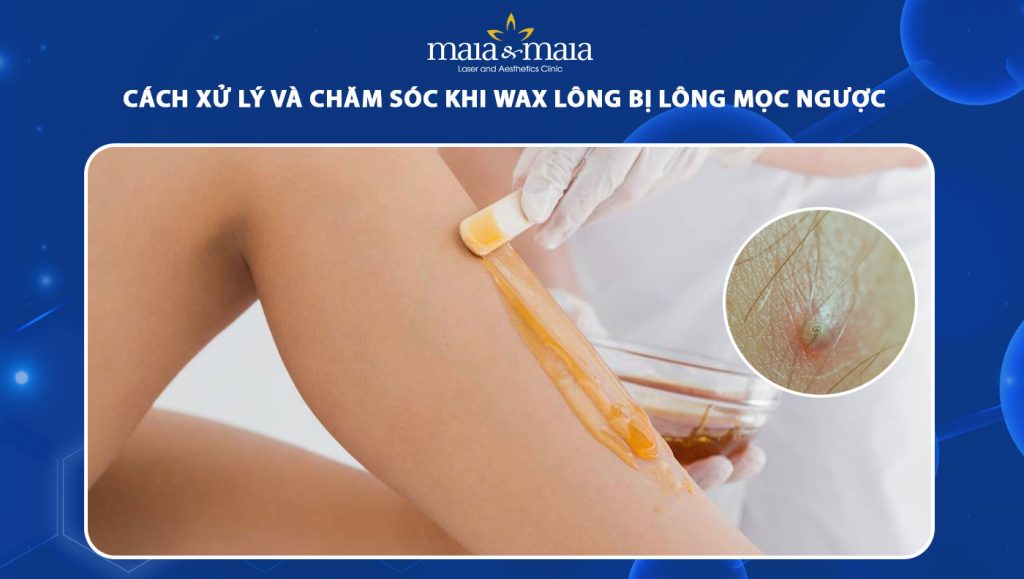 wax lông bị lông mọc ngược