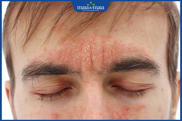 Điều trị viêm da cơ địa ở người lớn bằng công nghệ hiện đại 2 ảnh hưởng bệnh viêm da