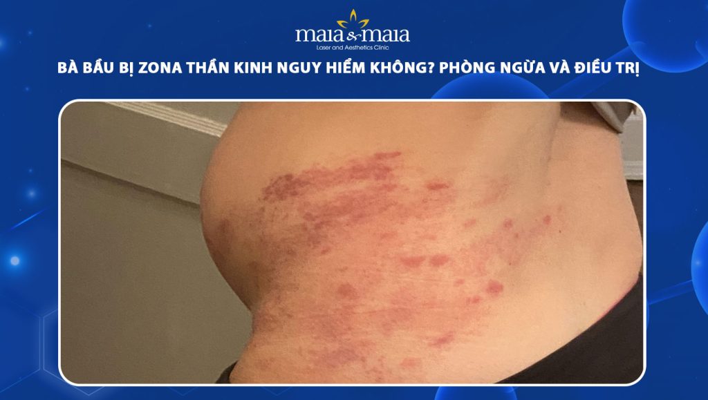 bà bầu bị zona thần kinh