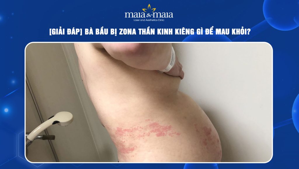 Bà bầu bị zona thần kinh kiêng gì