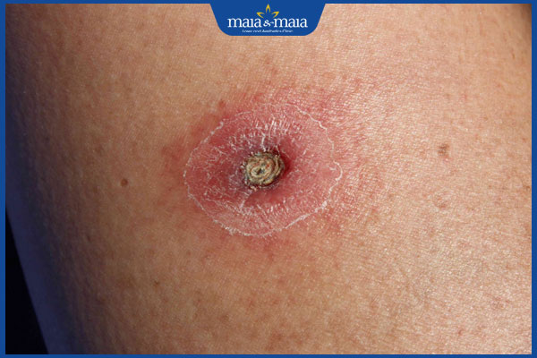 Nhiễm trùng da do vi khuẩn có nguy hiểm không? Cách điều trị 4 bệnh chốc lở