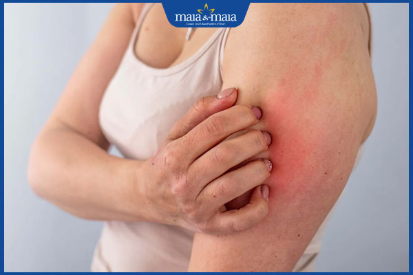 Viêm da thần kinh: Triệu chứng, nguyên nhân và cách điều trị 3 bệnh viêm da thần kinh