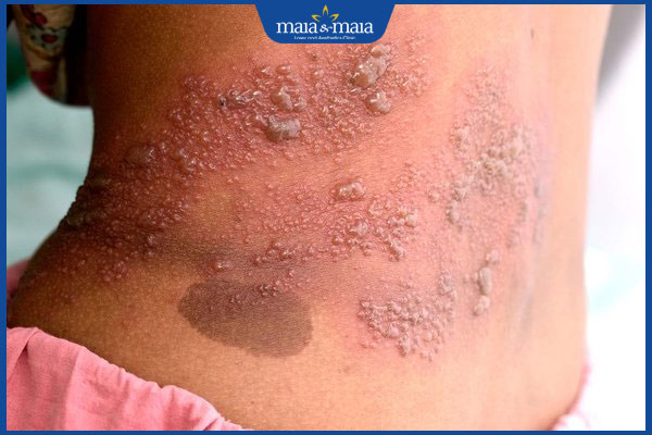 Bị zona thần kinh kiêng đi đám ma không? Lưu ý để nhanh khỏi 2 bệnh zona nặng