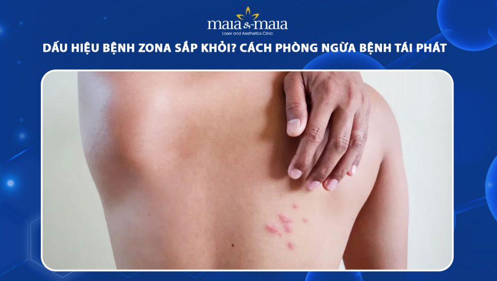 bệnh zona sắp khỏi