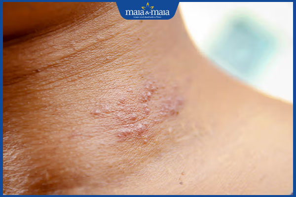 bị bệnh zona ở cổ