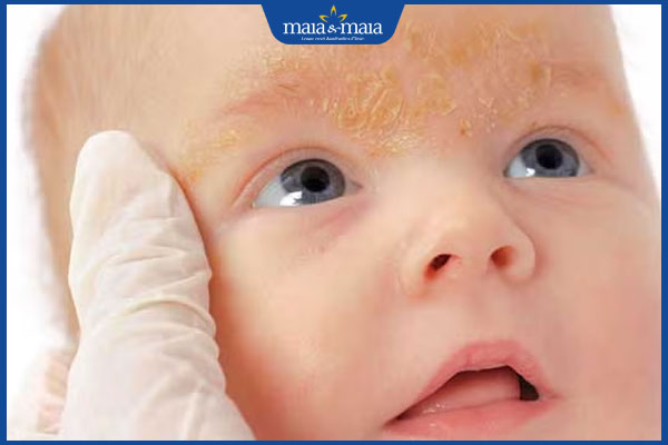 Viêm da cơ địa ở trẻ em: Dấu hiệu nhận biết và cách điều trị 4 bị viêm da cơ địa ở trẻ