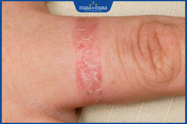 bị viêm da tiếp xúc ở tay