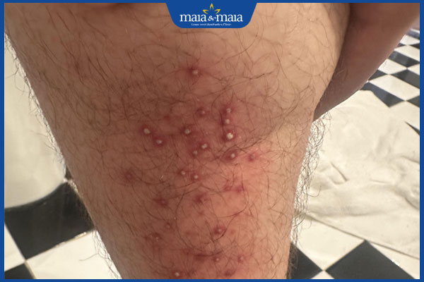 bị viêm lỗ chân lông ở bắp chân