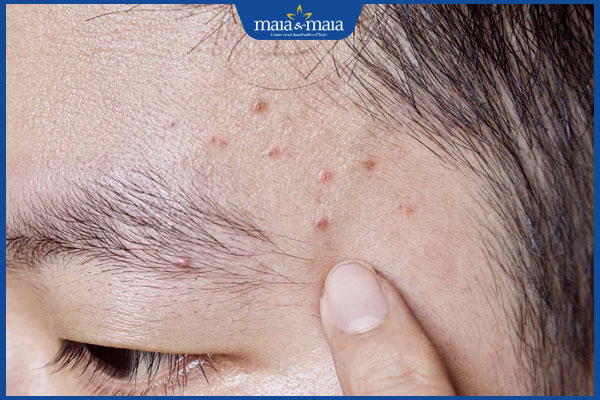 Viêm nang lông: Dấu hiệu, nguyên nhân và cách điều trị 3 bị viêm nang lông trên mặt