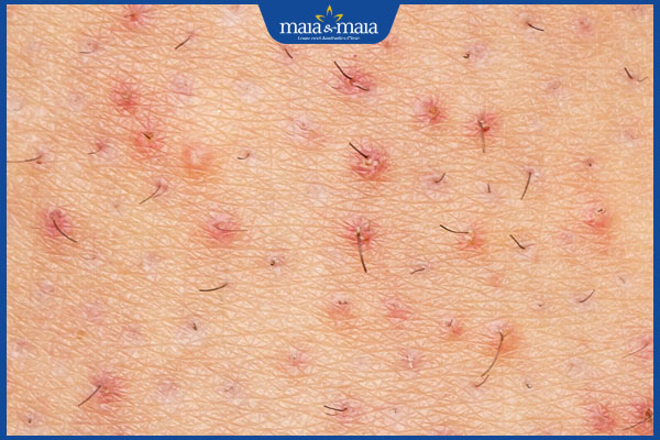 Bệnh viêm da: Nguyên nhân và cách điều trị hiệu quả 6 bị viêm nang lông