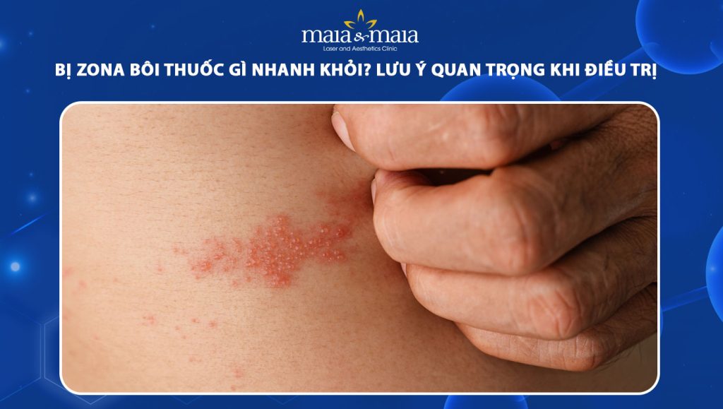 bị zona bôi thuốc gì nhanh khỏi