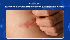 bị zona bôi thuốc gì nhanh khỏi