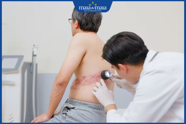 bị zona đi khám bác sĩ